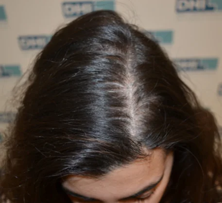 hair-transplant-treatment-in-thane-before.webp