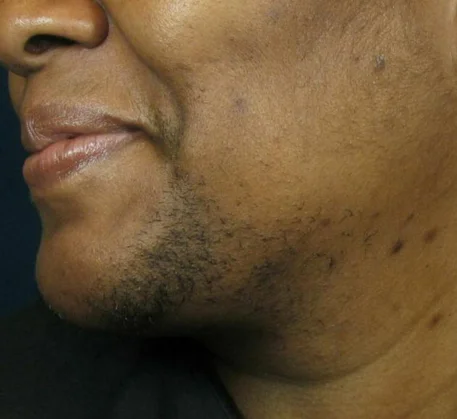 laser-treatment-in-thane-before.webp