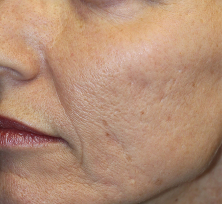 microneedling.png