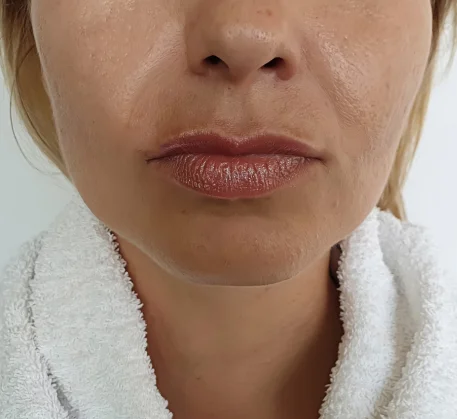 skin-care-treatment-in-thane-before.webp