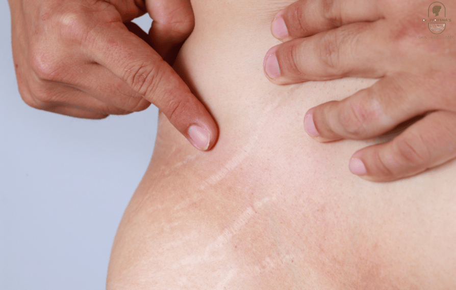 1720432095_stretch-mark-reduction-treatment-in-thane.png