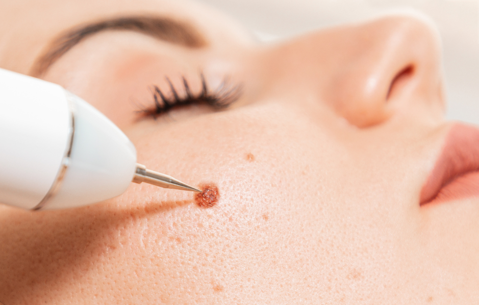 1749621650_big-image-birthmark-removal-treatment.png